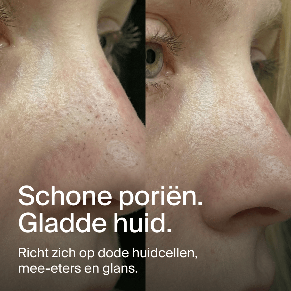 Nose Patches