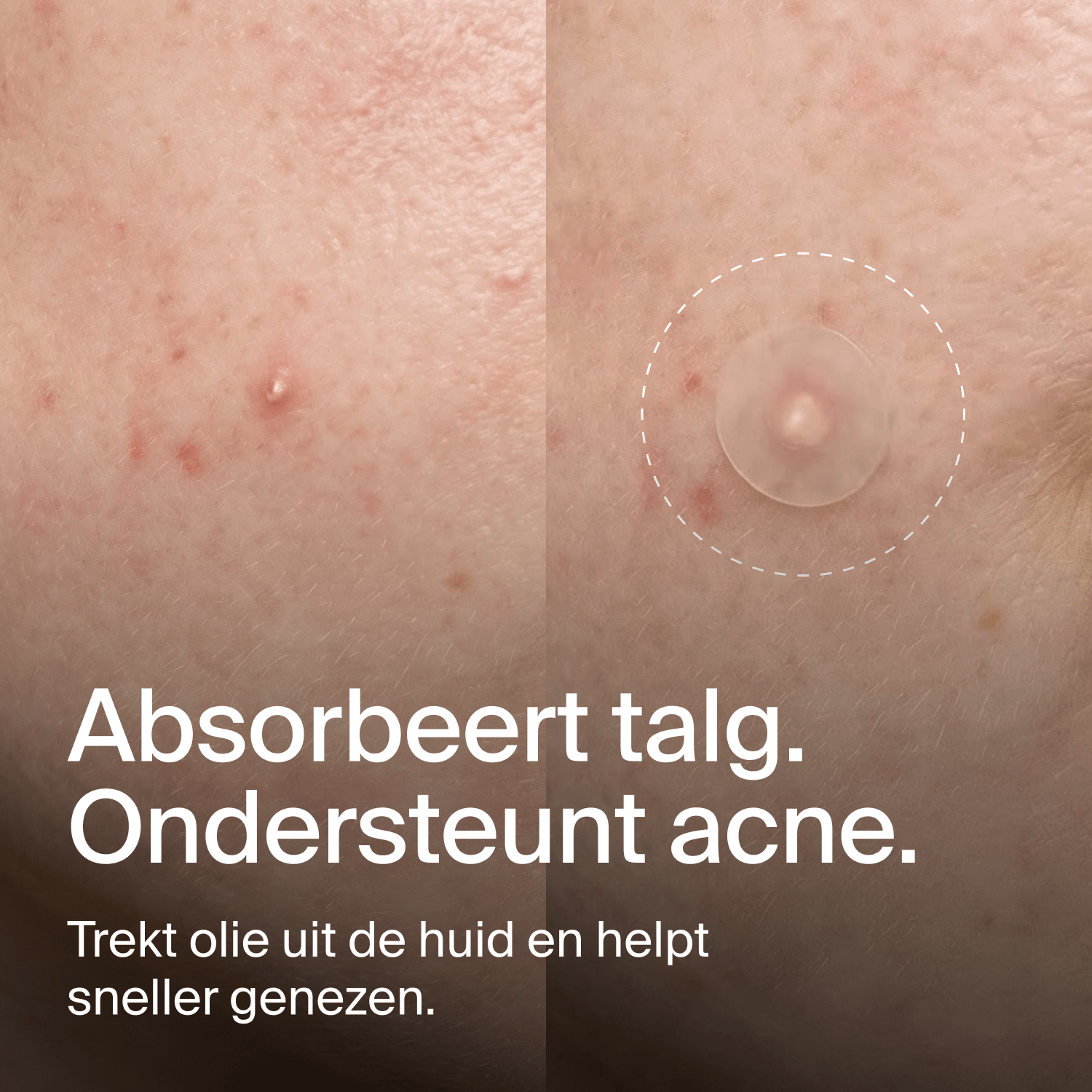 Clear Dots - Acne Patches