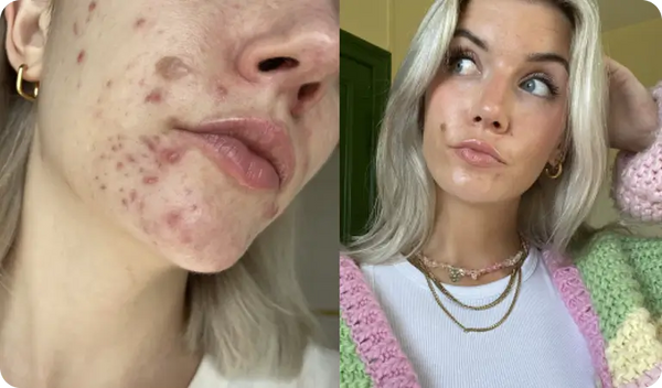 Stoppen met de pil was een nachtmerrie