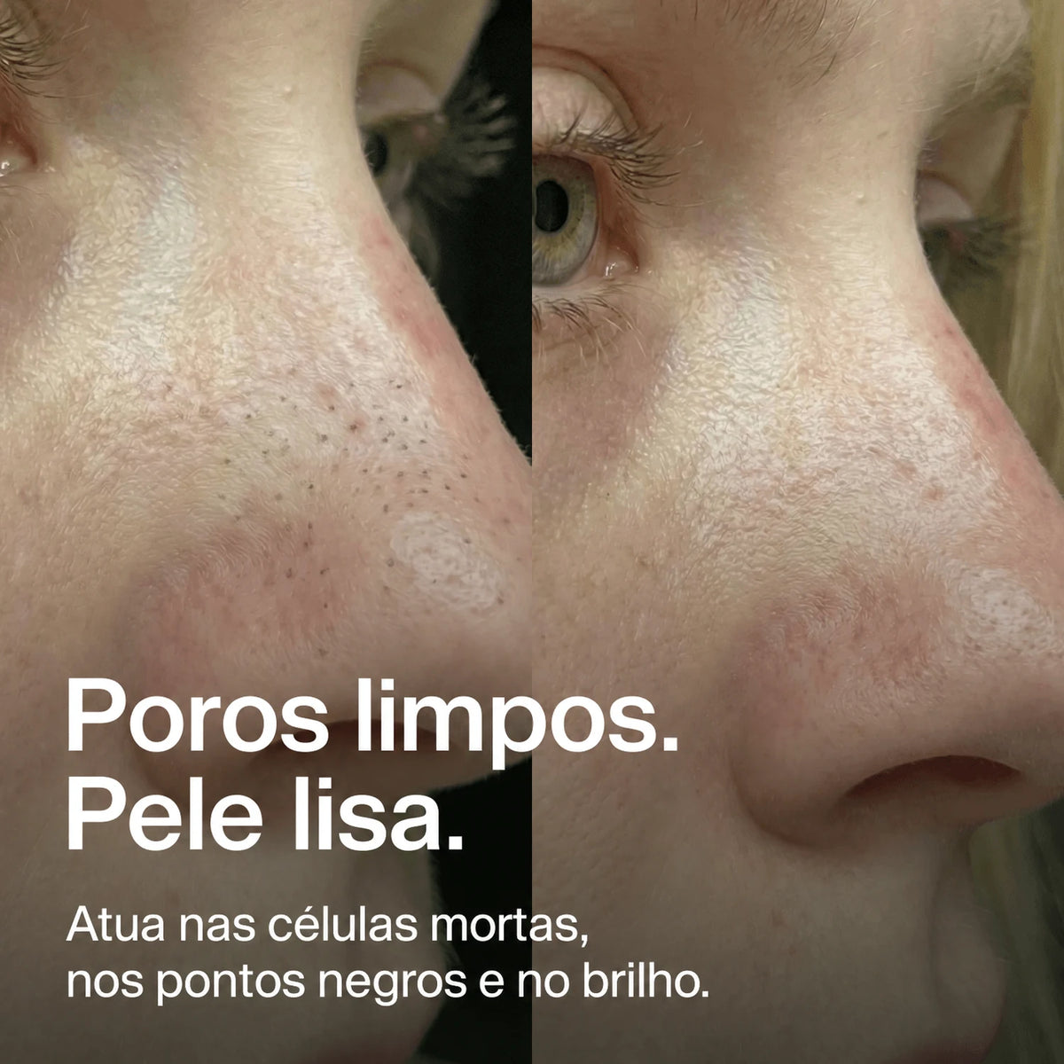 nose-patches gallery 5 (pt)