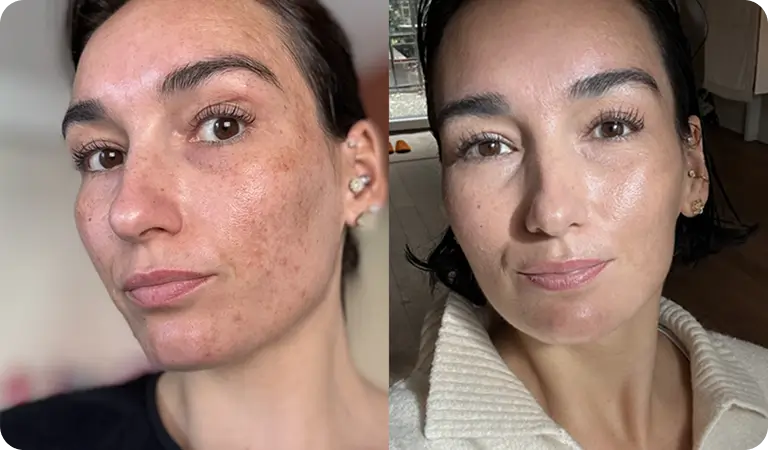 Esza before and after 10 weeks of Clear+