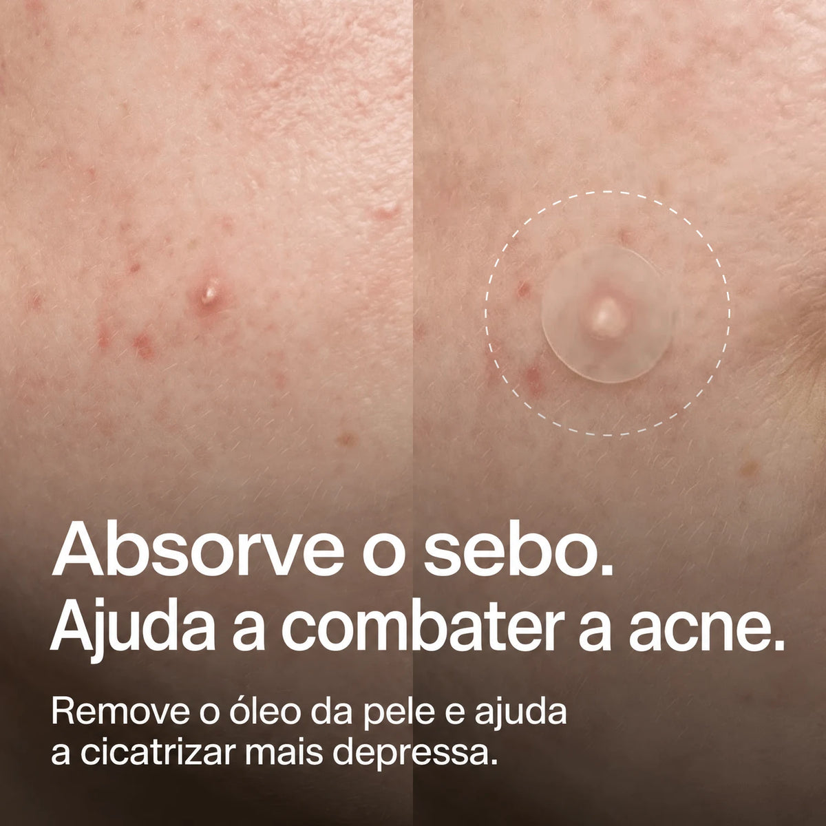 clear-dots-acne-patches gallery 2 (pt)